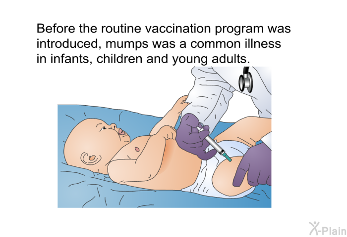 Before the routine vaccination program was introduced, mumps was a common illness in infants, children and young adults.