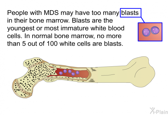 People with MDS may have too many blasts in their bone marrow. Blasts are the youngest or most immature white blood cells. In normal bone marrow, no more than 5 out of 100 white cells are blasts.