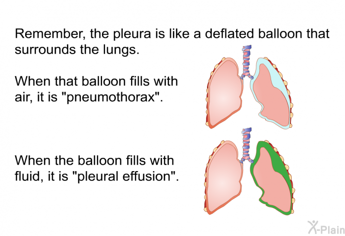 Remember, the pleura is like a deflated balloon that surrounds the lungs. When that balloon fills with air, it is “pneumothorax”. When the balloon fills with fluid, it is “pleural effusion”.