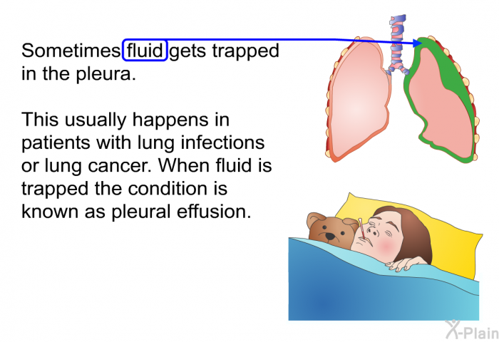 Sometimes fluid gets trapped in the pleura. This usually happens in patients with lung infections or lung cancer. When fluid is trapped the condition is known as pleural effusion.