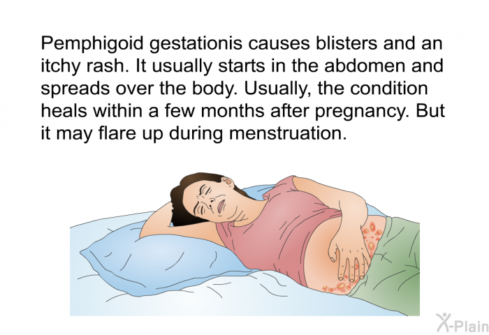 Pemphigoid gestationis causes blisters and an itchy rash. It usually starts in the abdomen and spreads over the body. Usually, the condition heals within a few months after pregnancy. But it may flare up during menstruation.