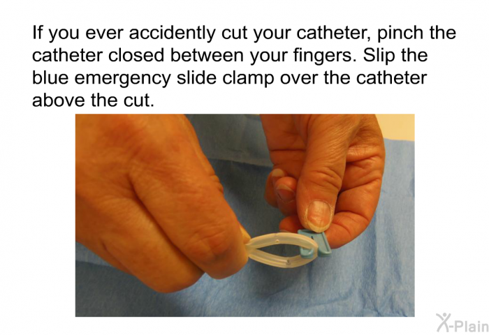 If you ever accidently cut your catheter, pinch the catheter closed between your fingers. Slip the blue emergency slide clamp over the catheter above the cut.