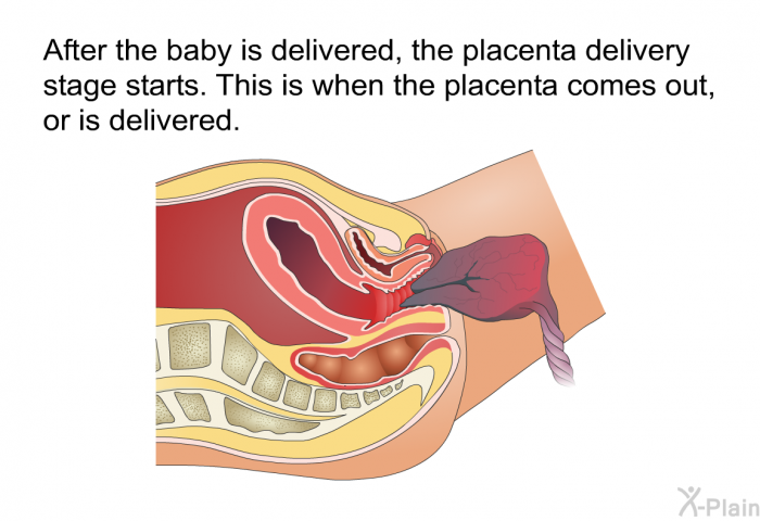 After the baby is delivered, the placenta delivery stage starts. This is when the placenta comes out, or is delivered.