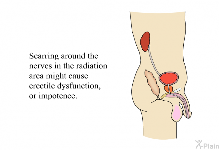 PatEdu Radiation Therapy for Prostate Cancer