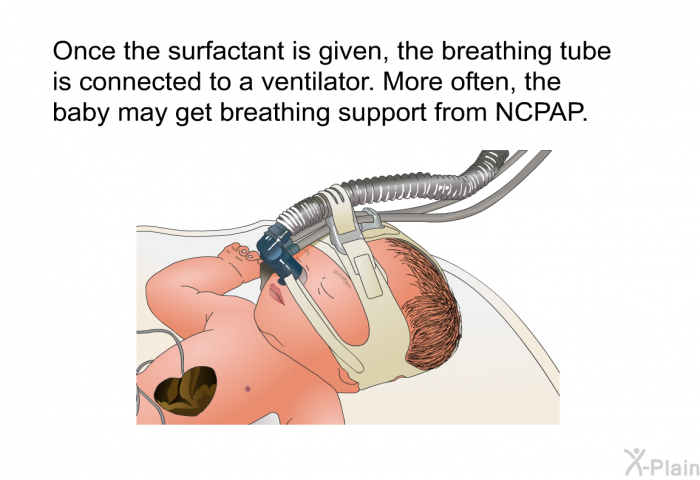 Once the surfactant is given, the breathing tube is connected to a ventilator. More often, the baby may get breathing support from NCPAP.