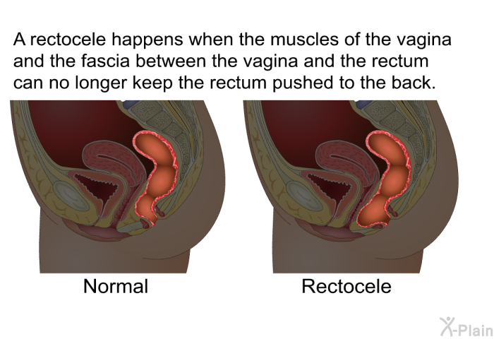 A rectocele happens when the muscles of the vagina and the fascia between the vagina and the rectum can no longer keep the rectum pushed to the back.