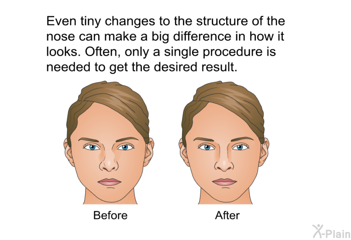 Even tiny changes to the structure of the nose can make a big difference in how it looks. Often, only a single procedure is needed to get the desired result.