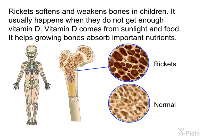 Rickets softens and weakens bones in children. It usually happens when they do not get enough vitamin D. Vitamin D comes from sunlight and food. It helps growing bones absorb important nutrients.