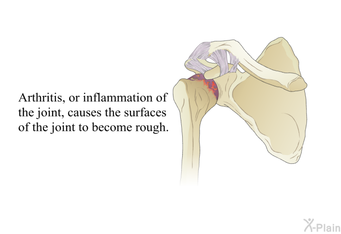 Arthritis, or inflammation of the joint, causes the surfaces of the joint to become rough.