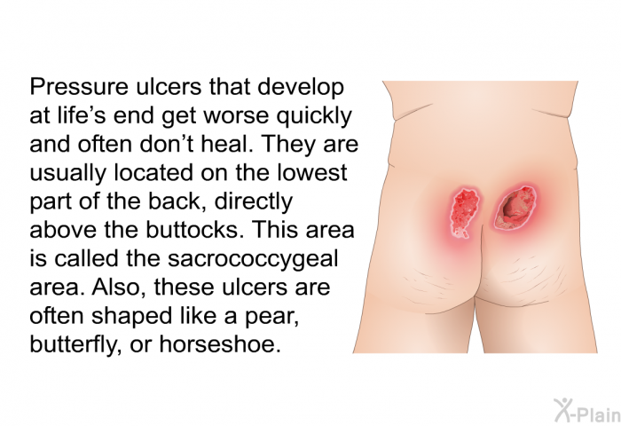 Pressure ulcers that develop at life's end get worse quickly and often don't heal. They are usually located on the lowest part of the back, directly above the buttocks. This area is called the sacrococcygeal area. Also, these ulcers are often shaped like a pear, butterfly, or horseshoe.