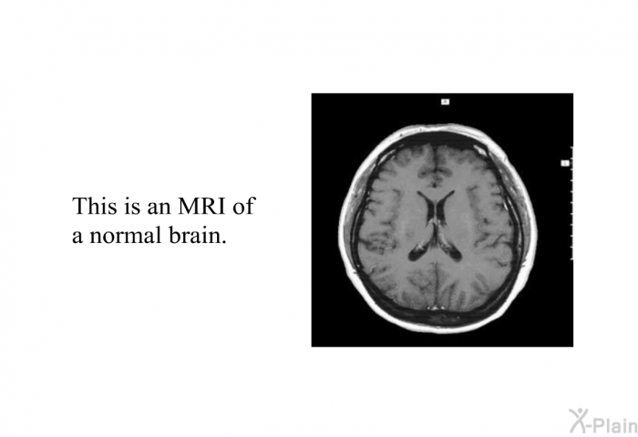 This is an MRI of a normal brain.