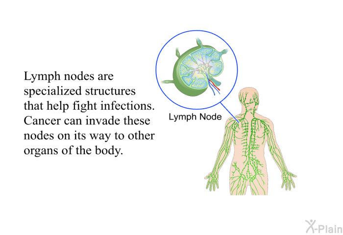 Lymph nodes are specialized structures that help fight infections. Cancer can invade these nodes on its way to other organs of the body.