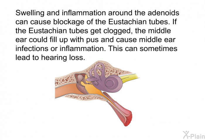 Swelling and inflammation around the adenoids can cause blockage of the Eustachian tubes. If the Eustachian tubes get clogged, the middle ear could fill up with pus and cause middle ear infections or inflammation. This can sometimes lead to hearing loss.