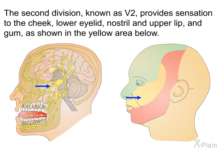 The second division, known as V2, provides sensation to the cheek, lower eyelid, nostril and upper lip, and gum, as shown in the yellow area below.