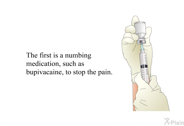 The first is a numbing medication, such as bupivacaine, to stop the pain.