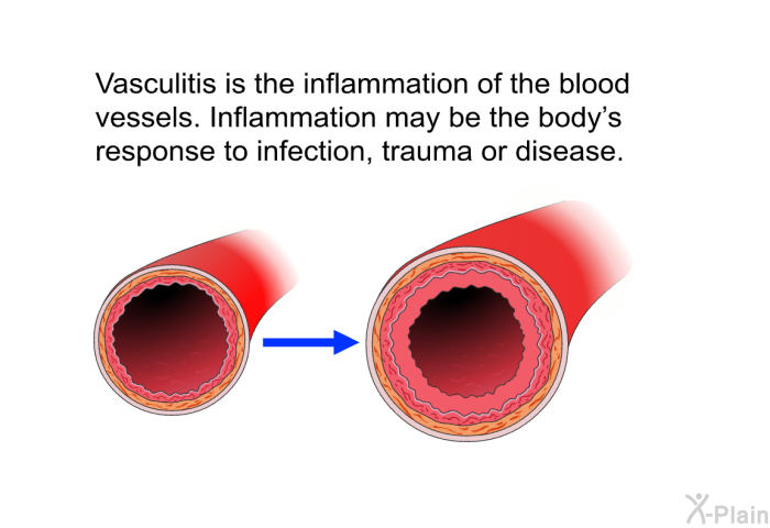 Vasculitis is the inflammation of the blood vessels. Inflammation may be the body's response to infection, trauma or disease.