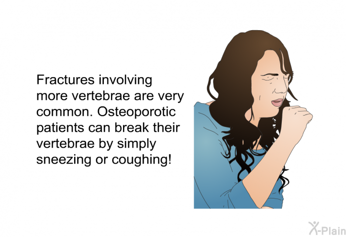 Fractures involving more vertebrae are very common. Osteoporotic patients can break their vertebrae by simply sneezing or coughing!