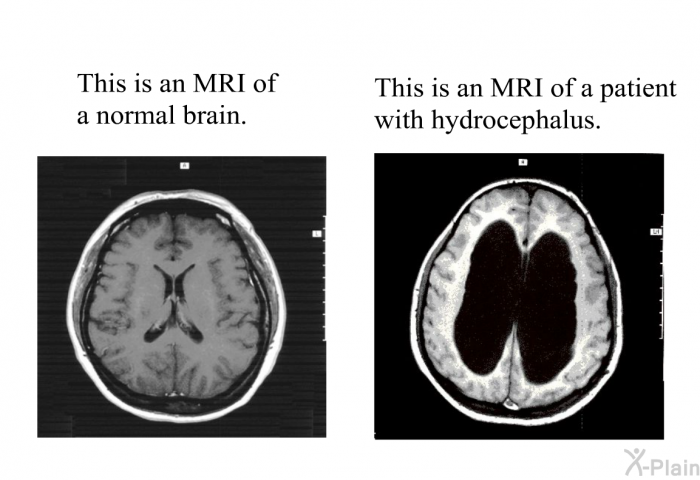 This is an MRI of a normal brain This is an MRI of a patient with hydrocephalus