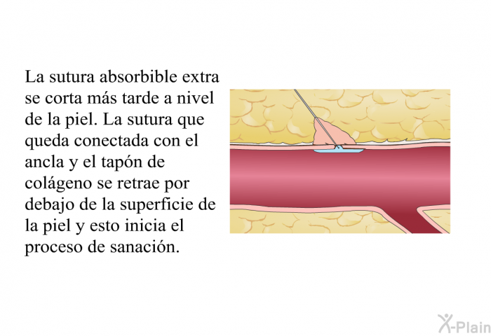 La sutura absorbible extra se corta ms tarde a nivel de la piel. La sutura que queda conectada con el ancla y el tapn de colgeno se retrae por debajo de la superficie de la piel y esto inicia el proceso de sanacin.