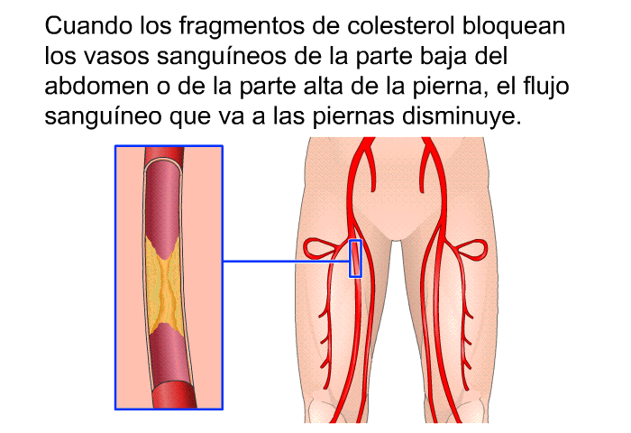 Cuando los fragmentos de colesterol bloquean los vasos sanguneos de la parte baja del abdomen o de la parte alta de la pierna, el flujo sanguneo que va a las piernas disminuye.