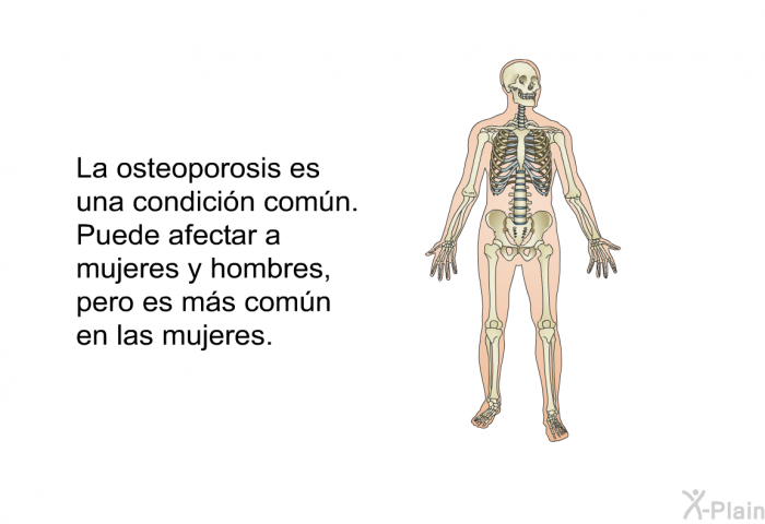 La osteoporosis es una condicin comn. Puede afectar a mujeres y hombres, pero es ms comn en las mujeres.
