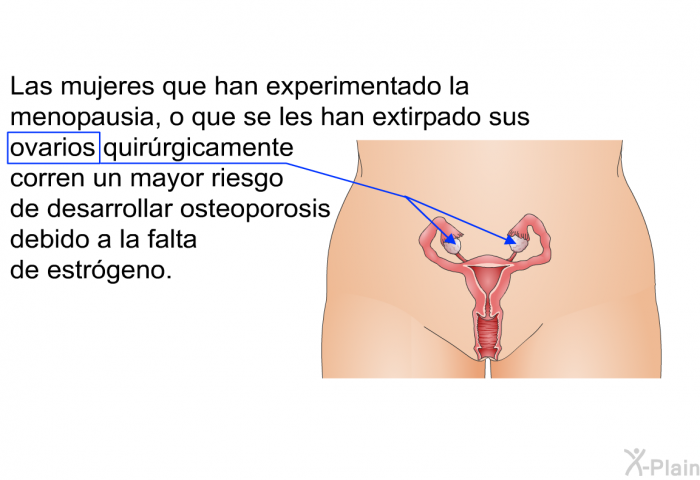 Las mujeres que han experimentado la menopausia, o que se les han extirpado sus ovarios quirrgicamente corren un mayor riesgo de desarrollar osteoporosis debido a la falta de estrgeno.