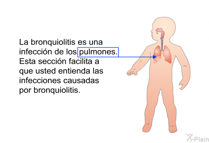 La bronquiolitis es una infeccin de los pulmones. Esta seccin facilita a que usted entienda las infecciones causadas por bronquiolitis.