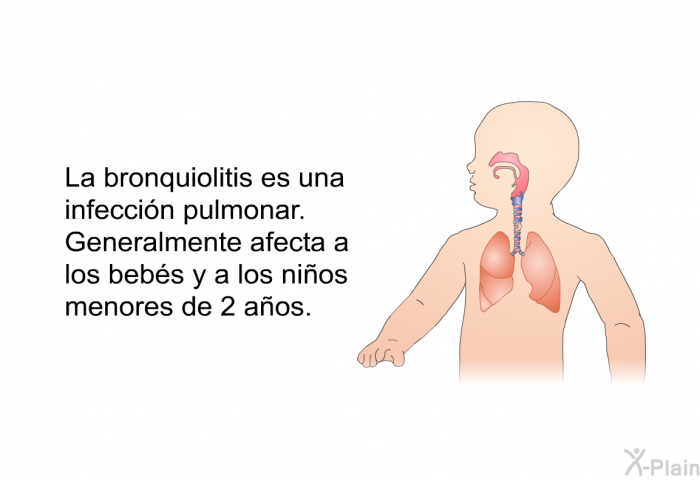 La bronquiolitis es una infecci�n pulmonar. Generalmente afecta a los beb�s y a los ni�os menores de 2 a�os.
