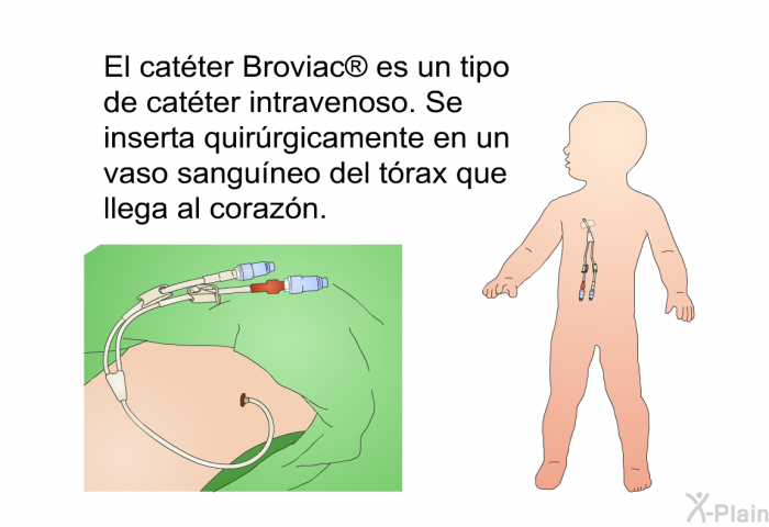 El catter Broviac<SUP>  </SUP>es un tipo de catter intravenoso. Se inserta quirrgicamente en un vaso sanguneo del trax que llega al corazn.
