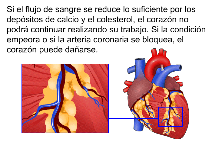 Si el flujo de sangre se reduce lo suficiente por los depsitos de calcio y el colesterol, el corazn no podr continuar realizando su trabajo. Si la condicin empeora o si la arteria coronaria se bloquea, el corazn puede daarse.