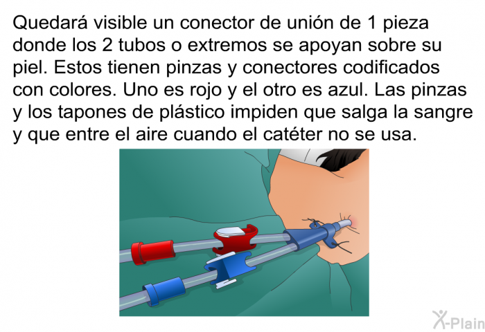 Quedar visible un conector de unin de 1 pieza donde los 2 tubos o extremos se apoyan sobre su piel. Estos tienen pinzas y conectores codificados con colores. Uno es rojo y el otro es azul. Las pinzas y los tapones de plstico impiden que salga la sangre y que entre el aire cuando el catter no se usa.