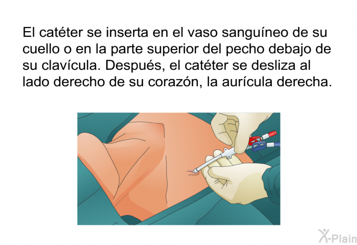 El catter se inserta en el vaso sanguneo de su cuello o en la parte superior del pecho debajo de su clavcula. Despus, el catter se desliza al lado derecho de su corazn, la aurcula derecha.