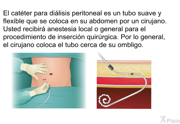 El catter para dilisis peritoneal es un tubo suave y flexible que se coloca en su abdomen por un cirujano. Usted recibir anestesia local o general para el procedimiento de insercin quirrgica. Por lo general, el cirujano coloca el tubo cerca de su ombligo.