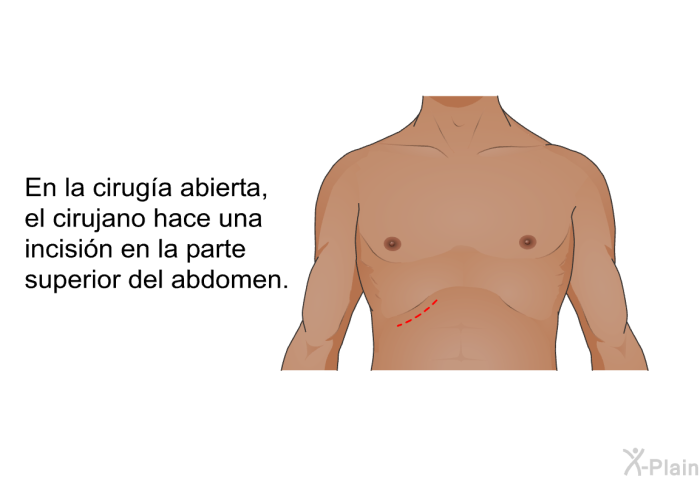En la cirug�a abierta, el cirujano hace una incisi�n en la parte superior del abdomen.