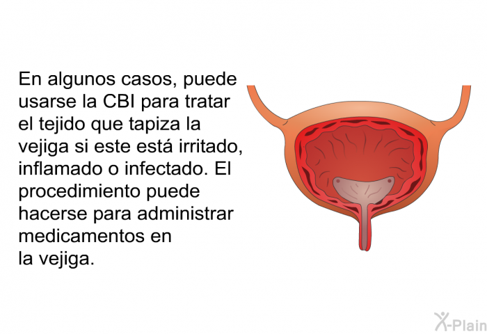 En algunos casos, puede usarse la CBI para tratar el tejido que tapiza la vejiga si este est irritado, inflamado o infectado. El procedimiento puede hacerse para administrar medicamentos en la vejiga.