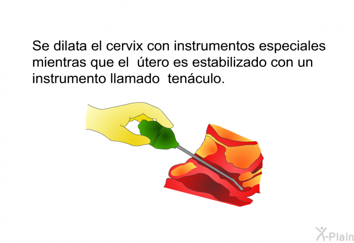 Se dilata el cervix con instrumentos especiales mientras que el �tero es estabilizado con un instrumento llamado <I>ten�culo</I>.