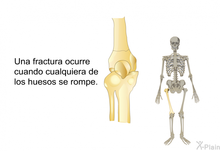 Una fractura ocurre cuando cualquiera de los huesos se rompe.