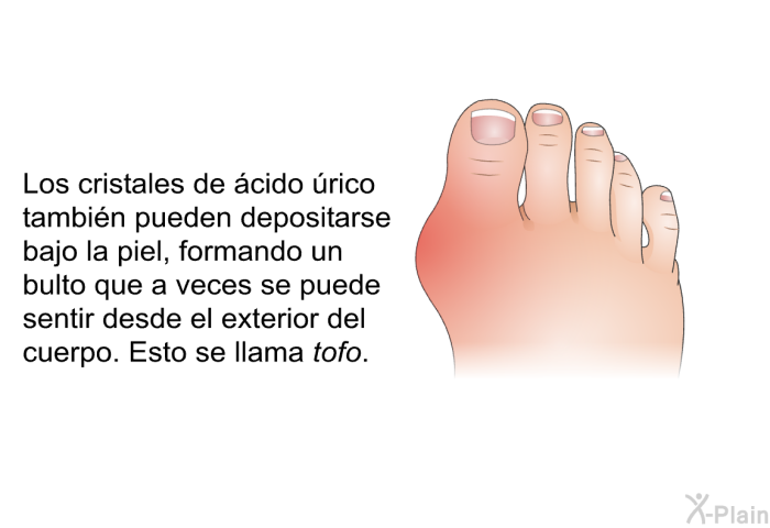 Los cristales de cido rico tambin pueden depositarse bajo la piel, formando un bulto que a veces se puede sentir desde el exterior del cuerpo. Esto se llama <I>tofo</I>.