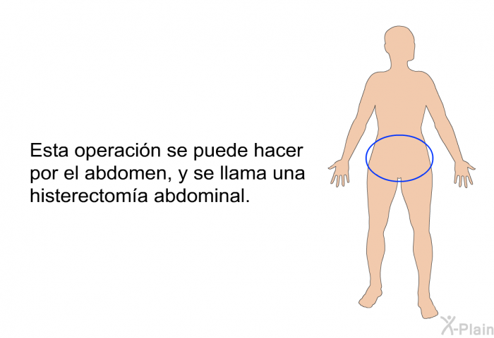 Esta operacin se puede hacer por el abdomen, y se llama una histerectoma abdominal.