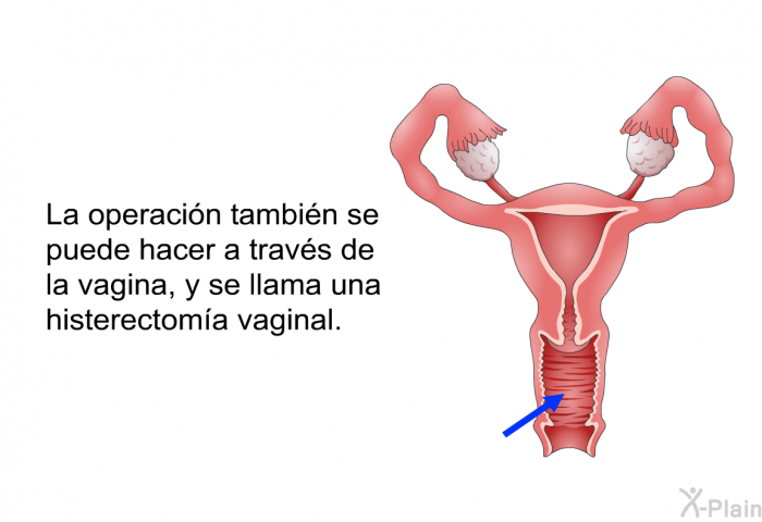 La operacin tambin se puede hacer a travs de la vagina, y se llama una histerectoma vaginal.