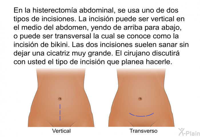 En la histerectoma abdominal, se usa uno de dos tipos de incisiones. La incisin puede ser vertical en el medio del abdomen, yendo de arriba para abajo, o puede ser transversal la cual se conoce como la incisin de bikini. Las dos incisiones suelen sanar sin dejar una cicatriz muy grande. El cirujano discutir con usted el tipo de incisin que planea hacerle.