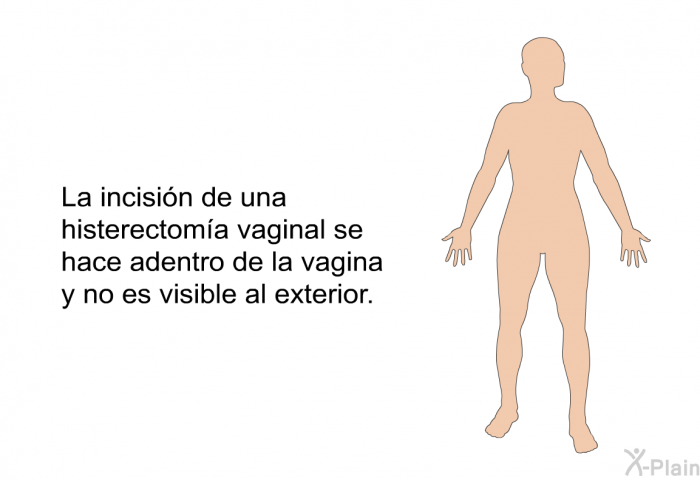 La incisin de una histerectoma vaginal se hace adentro de la vagina y no es visible al exterior.