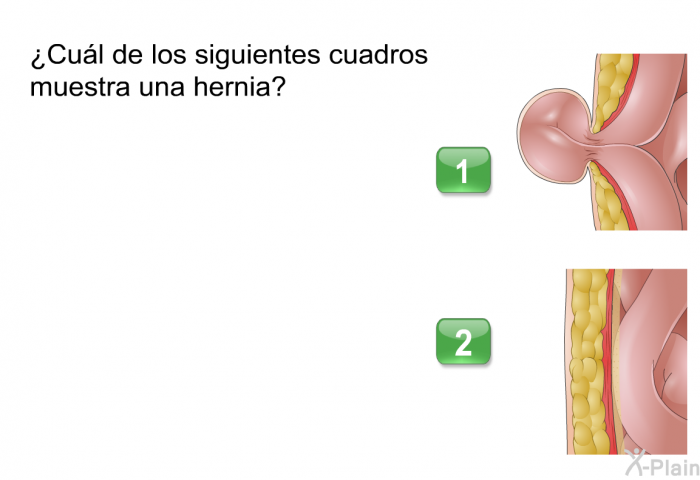 ¿Cul de los siguientes cuadros muestra una hernia?