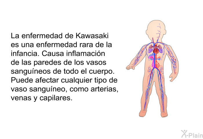 La enfermedad de Kawasaki es una enfermedad rara de la infancia. Causa inflamacin de las paredes de los vasos sanguneos de todo el cuerpo. Puede afectar cualquier tipo de vaso sanguneo, como arterias, venas y capilares.