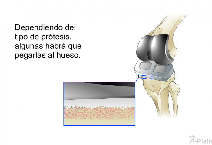 Dependiendo del tipo de prtesis, algunas habr que pegarlas al hueso.