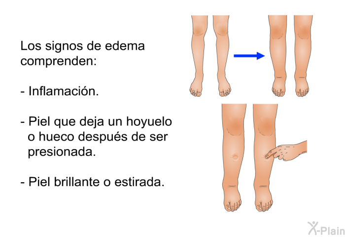 Los signos de edema comprenden:  Inflamacin. Piel que deja un hoyuelo o hueco despus de ser presionada. Piel brillante o estirada.