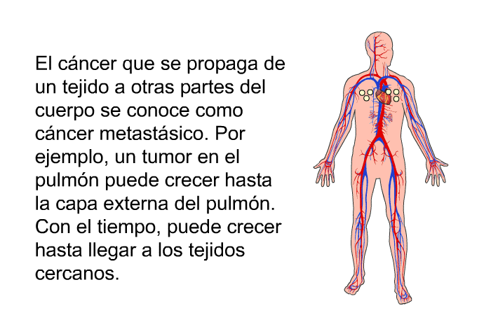 El cncer que se propaga de un tejido a otras partes del cuerpo se conoce como cncer metastsico. Por ejemplo, un tumor en el pulmn puede crecer hasta la capa externa del pulmn. Con el tiempo, puede crecer hasta llegar a los tejidos cercanos.