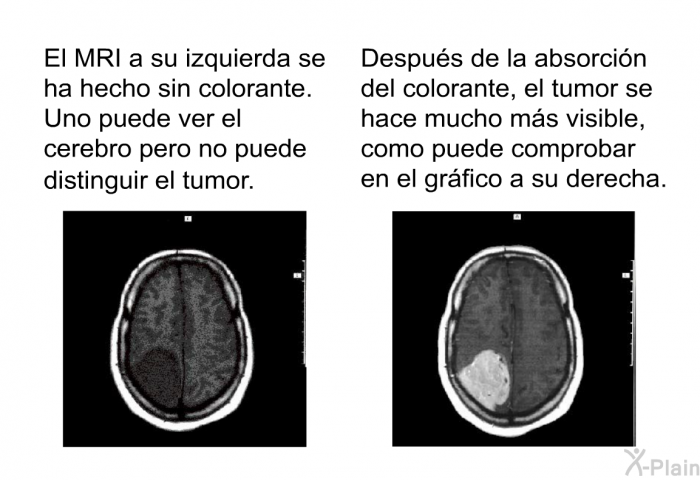 El MRI a su izquierda se ha hecho sin colorante. Uno puede ver el cerebro pero no puede distinguir el tumor. Despus de la absorcin del colorante, el tumor se hace mucho ms visible, como puede comprobar en el grfico a su derecha.