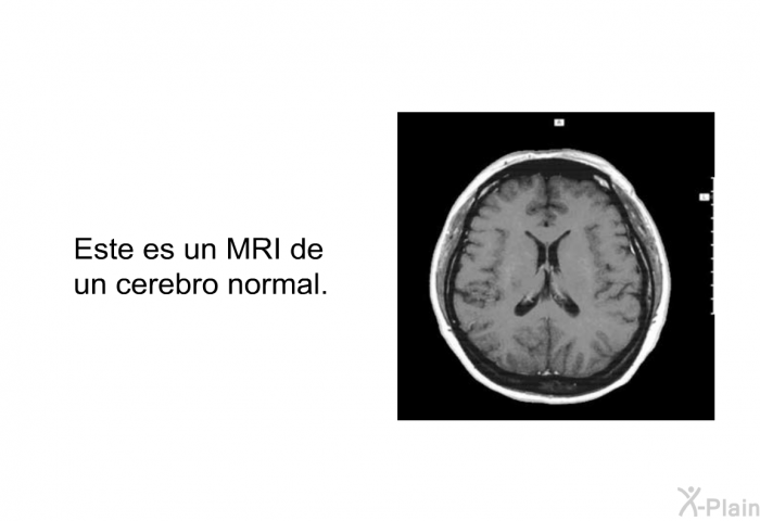 Este es un MRI de un cerebro normal.