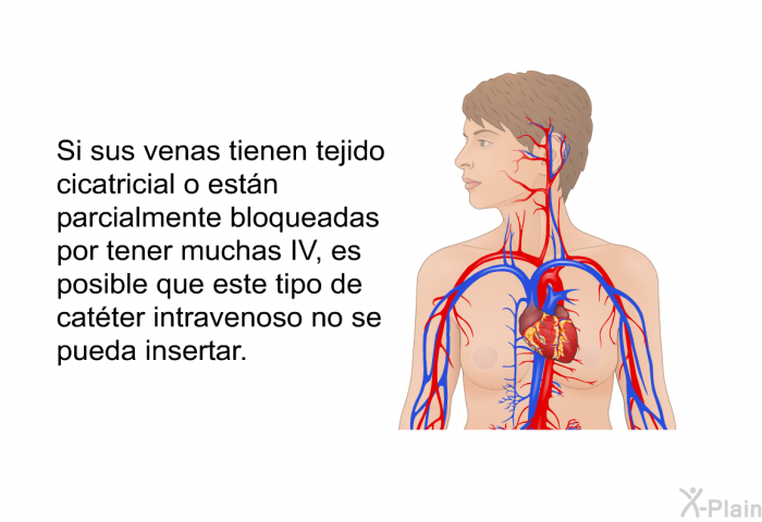 Si sus venas tienen tejido cicatricial o estn parcialmente bloqueadas por tener muchas IV, es posible que este tipo de catter intravenoso no se pueda insertar.